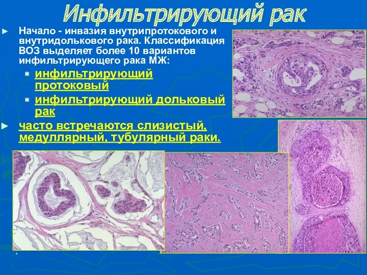 * Инфильтрирующий рак Начало - инвазия внутрипротокового и внутридолькового рака.