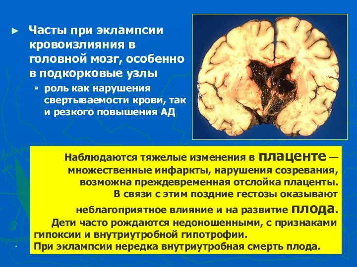 * Часты при эклампсии кровоизлияния в головной мозг, особенно в