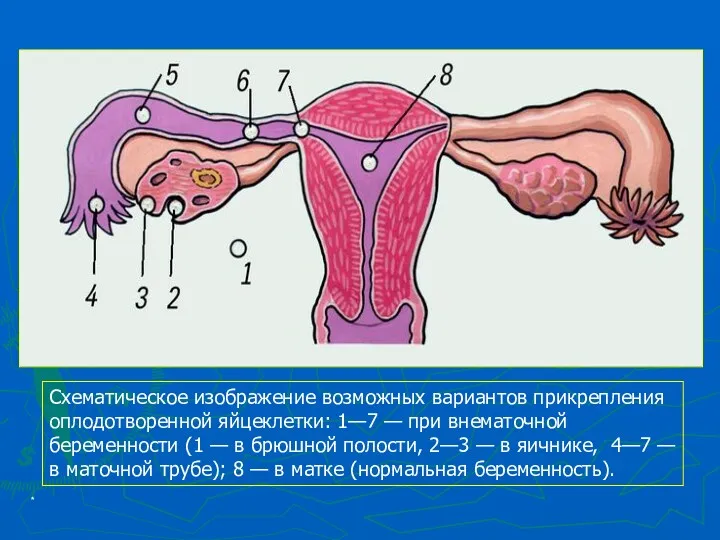 * Схематическое изображение возможных вариантов прикрепления оплодотворенной яйцеклетки: 1—7 —