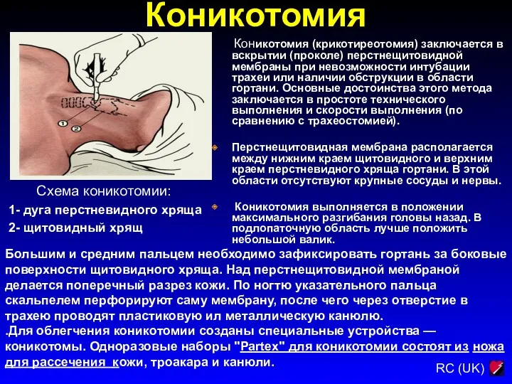 Коникотомия Схема коникотомии: 1- дуга перстневидного хряща 2- щитовидный хрящ Коникотомия (крикотиреотомия) заключается