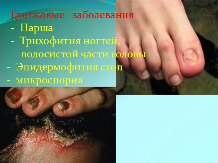 Грибковые заболевания - Парша - Трихофития ногтей, волосистой части головы Эпидермофития стоп микроспория