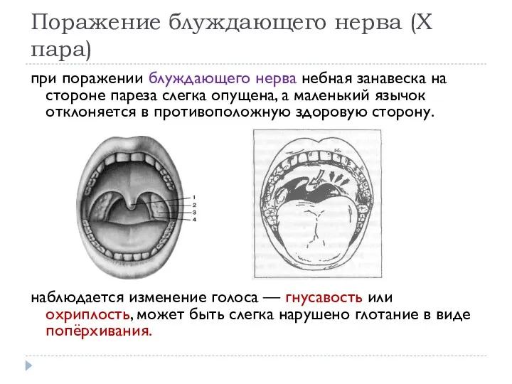 Поражение блуждающего нерва (X пара) при поражении блуждающего нерва небная