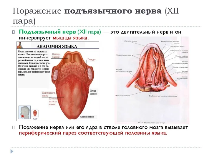 Поражение подъязычного нерва (XII пара) Подъязычный нерв (XII пара) —