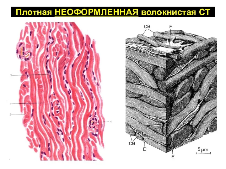 Плотная НЕОФОРМЛЕННАЯ волокнистая СТ