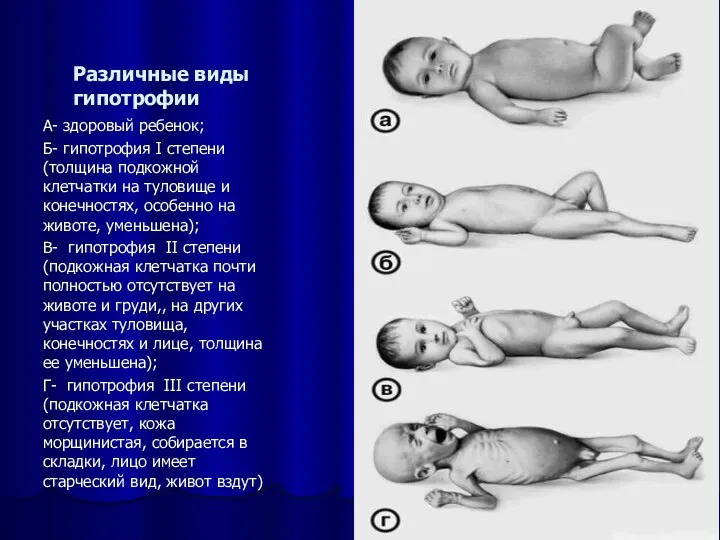 Различные виды гипотрофии А- здоровый ребенок; Б- гипотрофия I степени