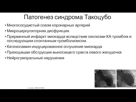 Патогенез синдрома Такоцубо Многососудистый спазм коронарных артерий Микроциркуляторная дисфункция Прерванный