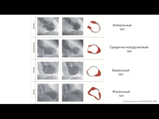 Апикальный тип Срединно-желудочковый тип Базальный тип Фокальный тип