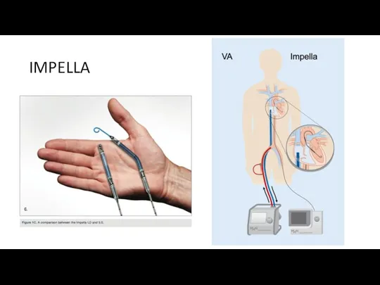 IMPELLA