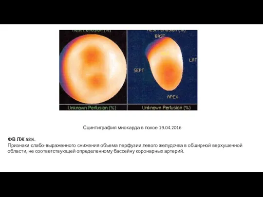 Сцинтиграфия миокарда в покое 19.04.2016 ФВ ЛЖ 58%. Признаки слабо-выраженного