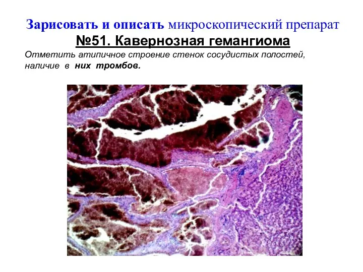 Зарисовать и описать микроскопический препарат №51. Кавернозная гемангиома Отметить атипичное строение стенок сосудистых