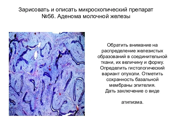 Зарисовать и описать микроскопический препарат №56. Аденома молочной железы Обратить внимание на распределение