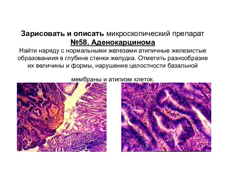 Зарисовать и описать микроскопический препарат №58. Аденокарцинома Найти наряду с нормальными железами атипичные