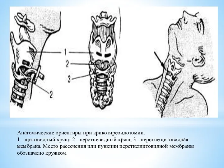 Анатомические ориентиры при крикотиреоидотомии. 1 - щитовидный хрящ; 2 -