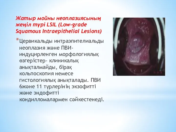 Жатыр мойны неоплазиясының жеңіл түрі LSIL (Low-grade Squamous Intraepithelial Lesions)