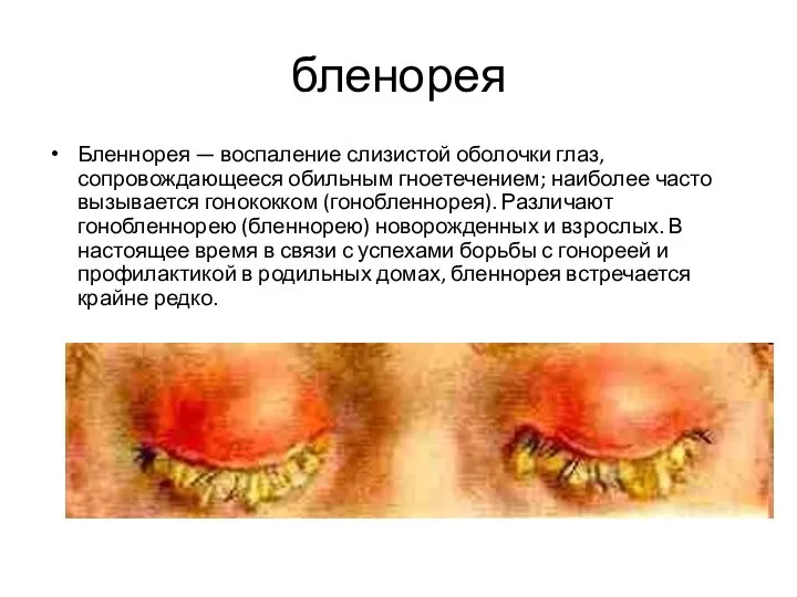 бленорея Бленнорея — воспаление слизистой оболочки глаз, сопровождающееся обильным гноетечением; наиболее часто вызывается