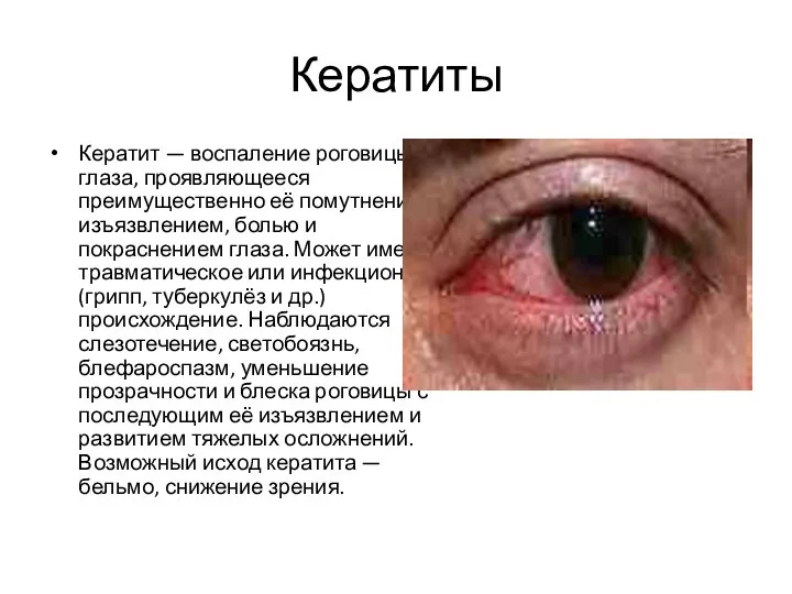 Кератиты Кератит — воспаление роговицы глаза, проявляющееся преимущественно её помутнением, изъязвлением, болью и