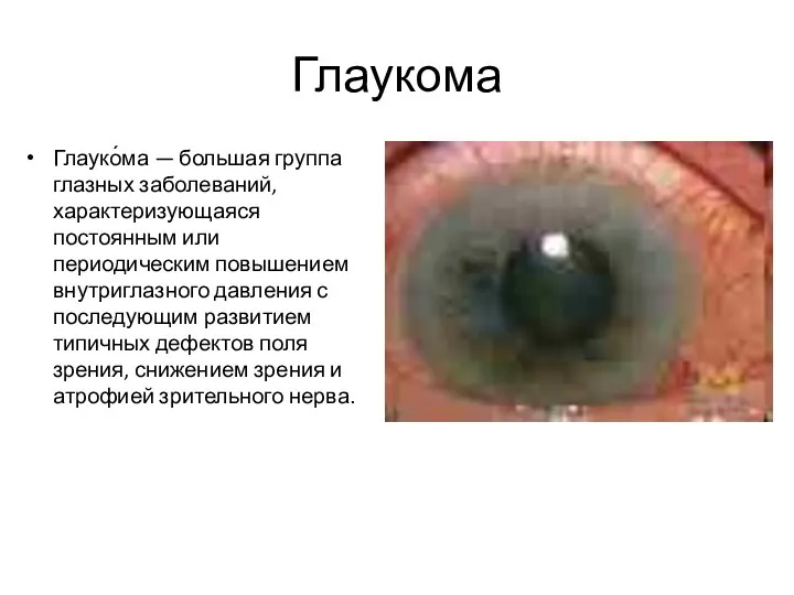 Глаукома Глауко́ма — большая группа глазных заболеваний, характеризующаяся постоянным или периодическим повышением внутриглазного