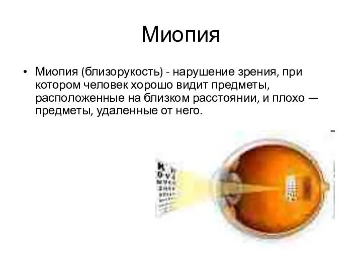 Миопия Миопия (близорукость) - нарушение зрения, при котором человек хорошо видит предметы, расположенные