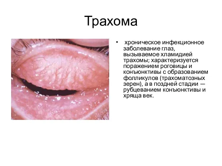 Трахома хроническое инфекционное заболевание глаз, вызываемое хламидией трахомы; характеризуется поражением роговицы и конъюнктивы