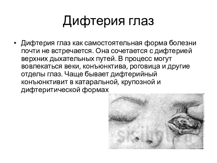 Дифтерия глаз Дифтерия глаз как самостоятельная форма болезни почти не встречается. Она сочетается