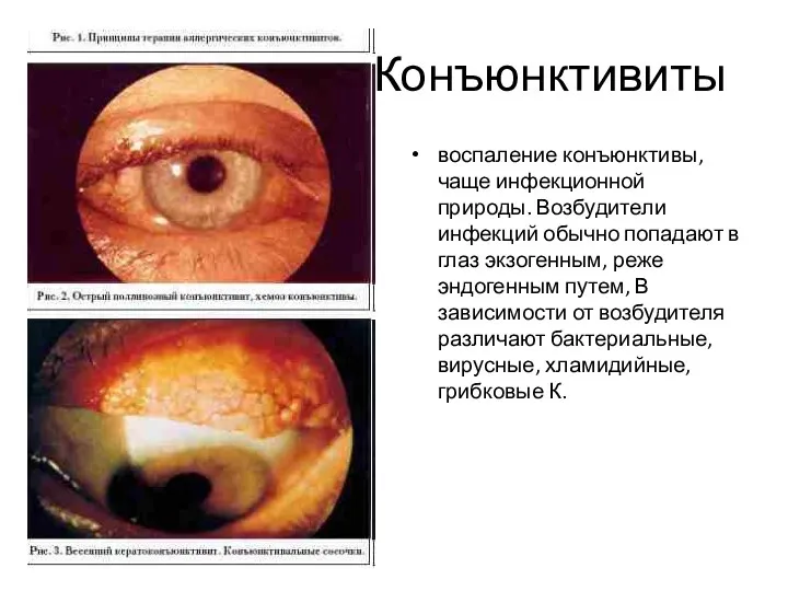 Конъюнктивиты воспаление конъюнктивы, чаще инфекционной природы. Возбудители инфекций обычно попадают в глаз экзогенным,