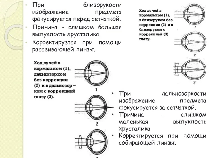 При близорукости изображение предмета фокусируется перед сетчаткой. Причина - слишком