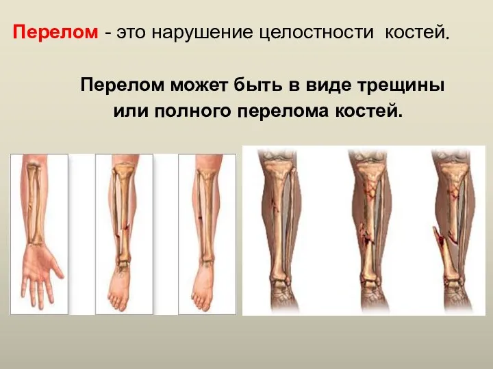 Перелом - это нарушение целостности костей. Перелом может быть в