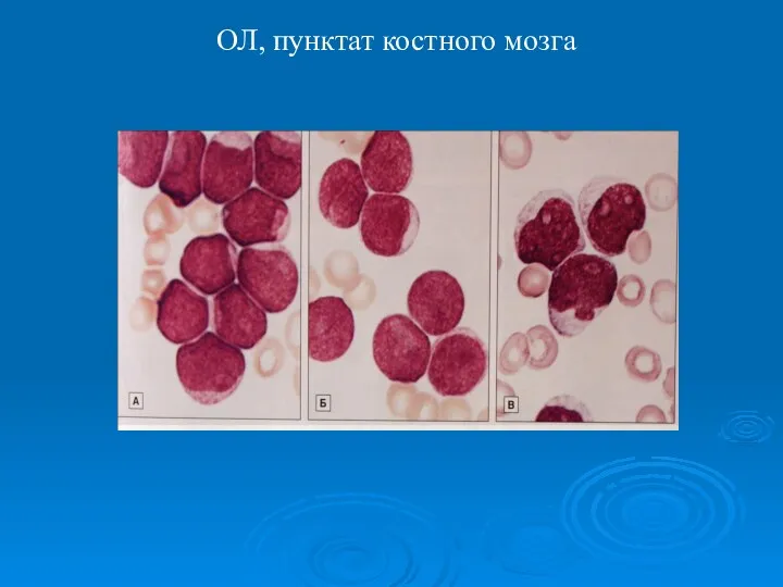 ОЛ, пунктат костного мозга