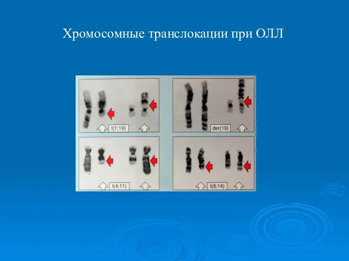 Хромосомные транслокации при ОЛЛ