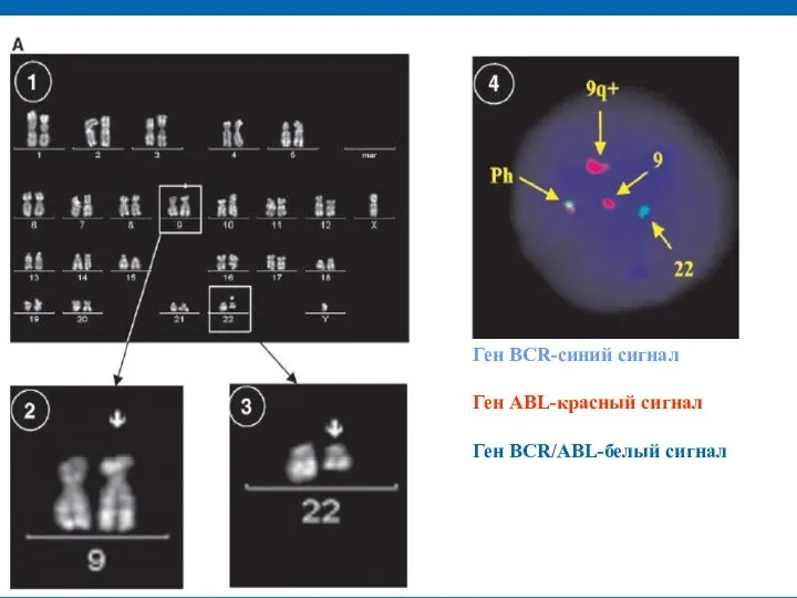 Ген BCR-синий сигнал Ген ABL-красный сигнал Ген BCR/ABL-белый сигнал