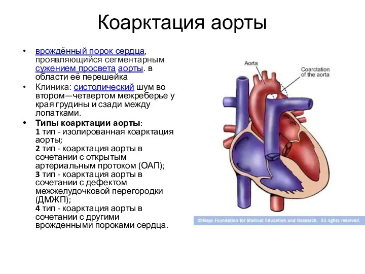 Коарктация аорты врождённый порок сердца, проявляющийся сегментарным сужением просвета аорты.