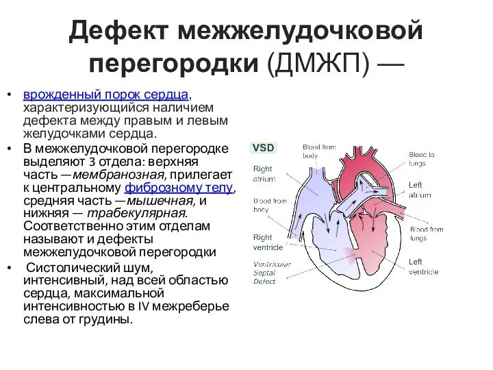 Дефект межжелудочковой перегородки (ДМЖП) — врожденный порок сердца, характеризующийся наличием