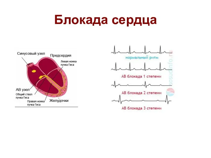 Блокада сердца