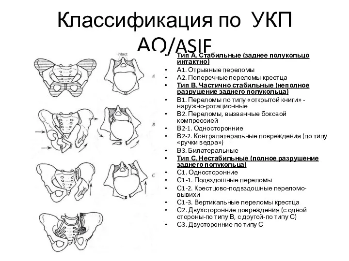 Классификация по УКП АО/ASIF Тип А. Стабильные (заднее полукольцо интактно)