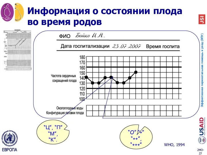 Информация о состоянии плода во время родов WHO, 1994 “O”,“+” “++”, “+++” “Ц”, “П” “М”, “К”.