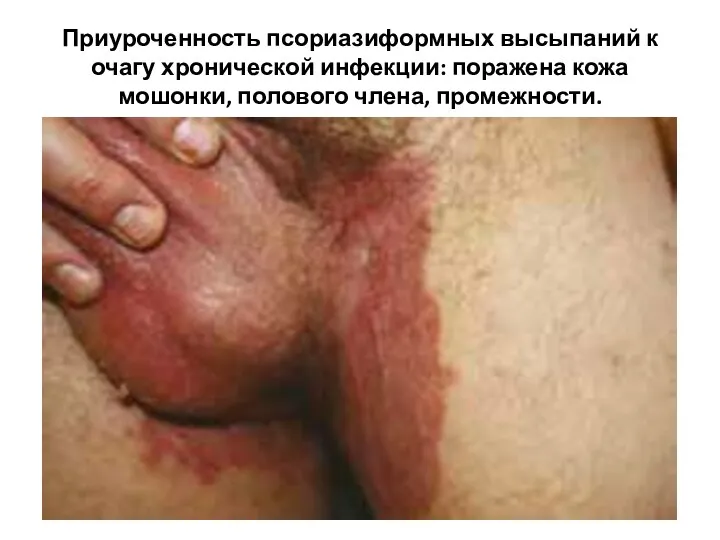 Приуроченность псориазиформных высыпаний к очагу хронической инфекции: поражена кожа мошонки, полового члена, промежности.