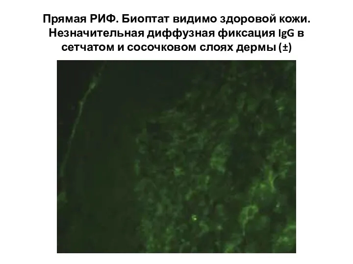 Прямая РИФ. Биоптат видимо здоровой кожи. Незначительная диффузная фиксация IgG