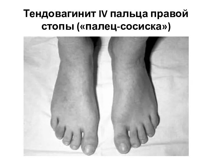 Тендовагинит IV пальца правой стопы («палец-сосиска»)