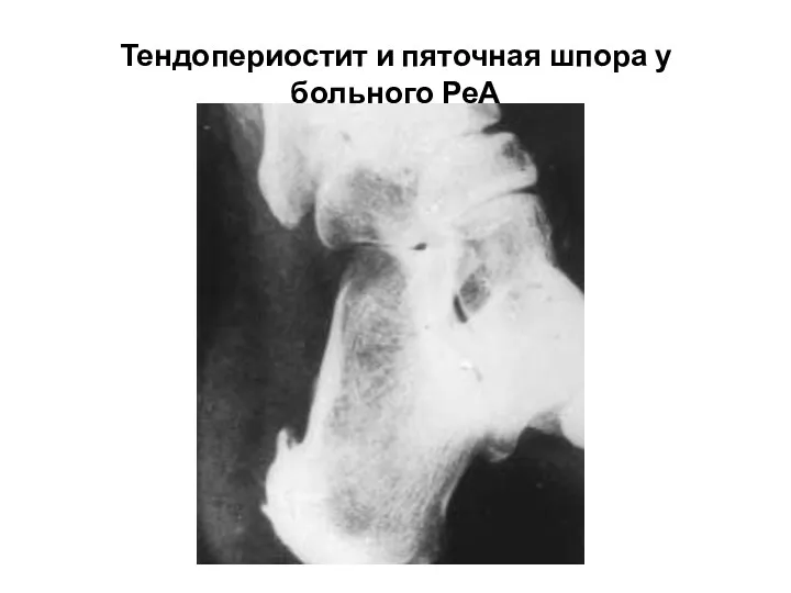 Тендопериостит и пяточная шпора у больного РеА