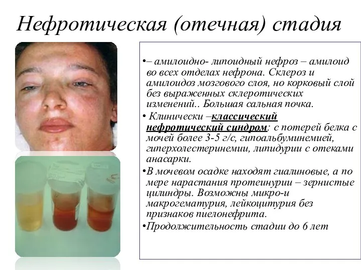 Нефротическая (отечная) стадия – амилоидно- липоидный нефроз – амилоид во