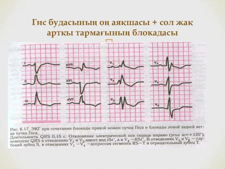 Гис будасының оң аяқшасы + сол жақ артқы тармағының блокадасы