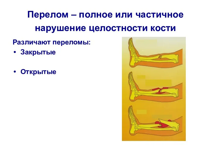 Перелом – полное или частичное нарушение целостности кости Различают переломы: Закрытые Открытые