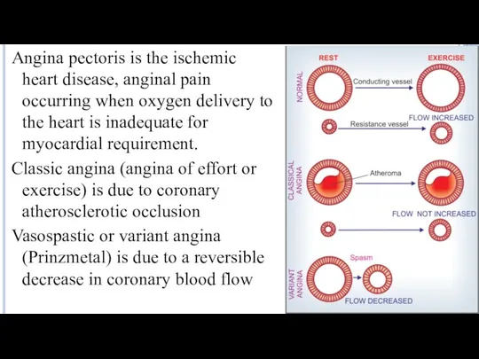 Angina pectoris is the ischemic heart disease, anginal pain occurring