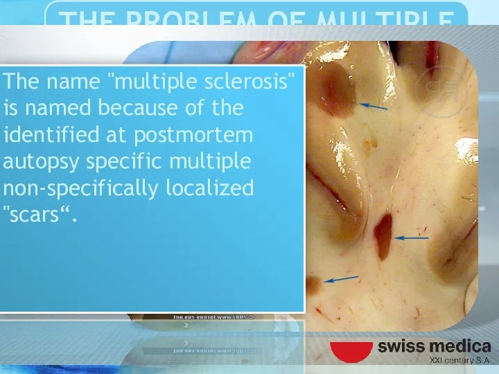 The name "multiple sclerosis" is named because of the identified