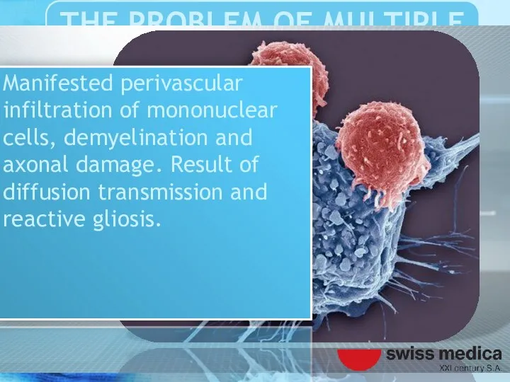 Manifested perivascular infiltration of mononuclear cells, demyelination and axonal damage.