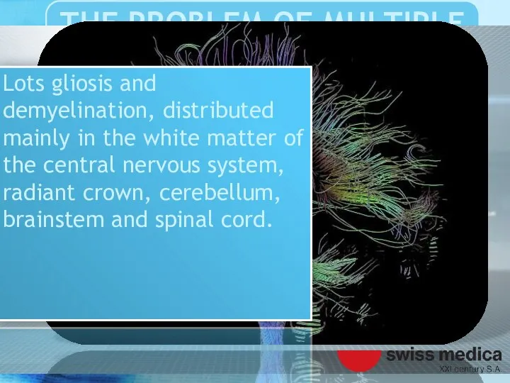 Lots gliosis and demyelination, distributed mainly in the white matter