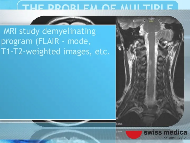 MRI study demyelinating program (FLAIR - mode, T1-T2-weighted images, etc.