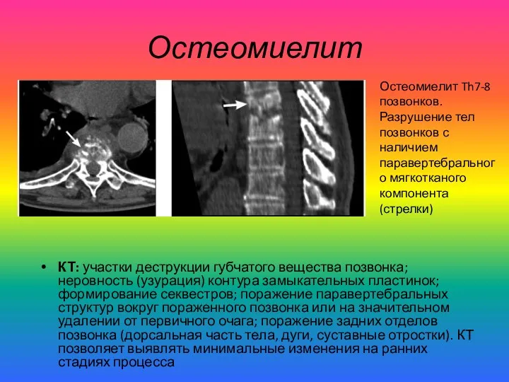 Остеомиелит КТ: участки деструкции губчатого вещества позвонка; неровность (узурация) контура