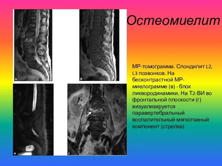 Остеомиелит МР-томограмма. Спондилит L2, L3 позвонков. На бесконтрастной МР-миелограмме (в)