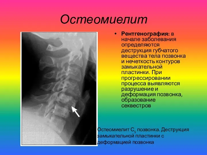 Остеомиелит Рентгенография: в начале заболевания определяются деструкция губчатого вещества тела